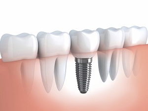 Implante dentário